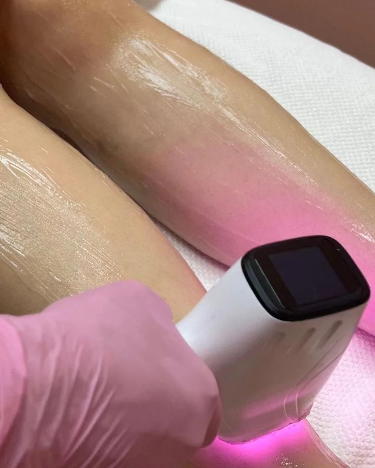 Aplicación de láser sobre la piel con guantes rosados
